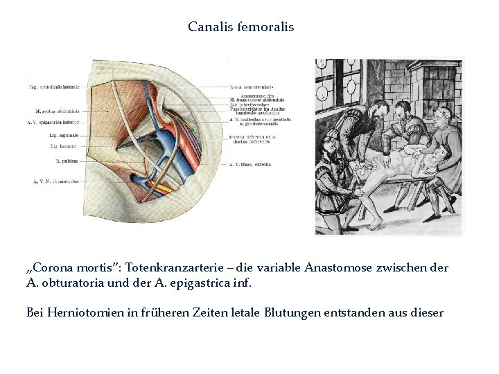 Canalis femoralis „Corona mortis”: Totenkranzarterie – die variable Anastomose zwischen der A. obturatoria und