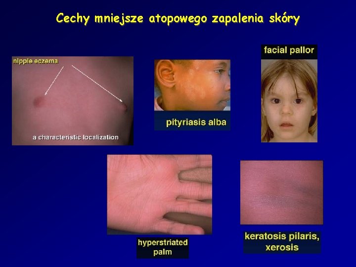 Cechy mniejsze atopowego zapalenia skóry 