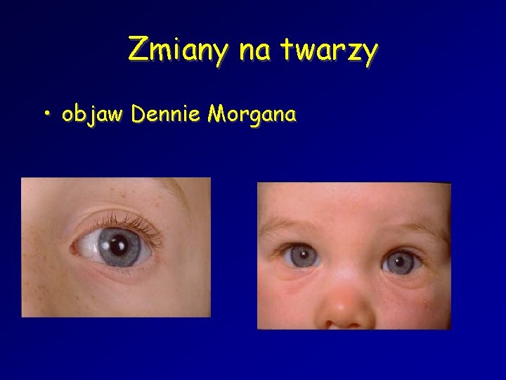 Zmiany na twarzy • objaw Dennie Morgana 