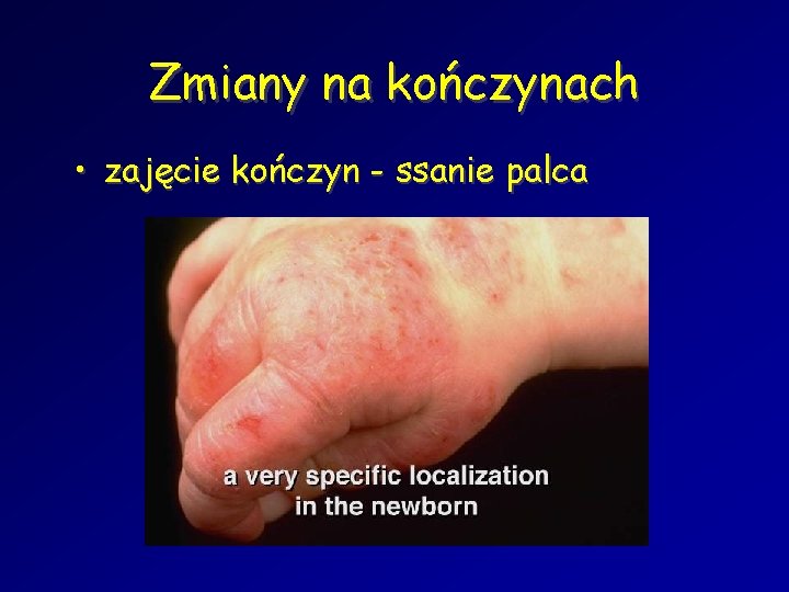 Zmiany na kończynach • zajęcie kończyn - ssanie palca 