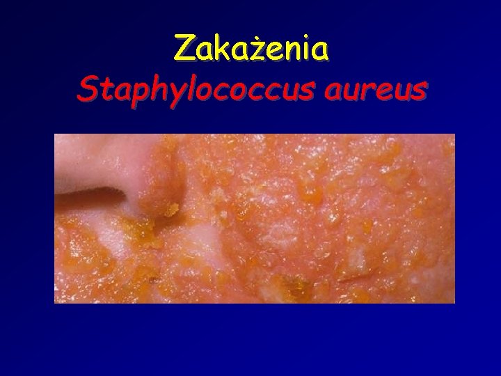 Zakażenia Staphylococcus aureus 