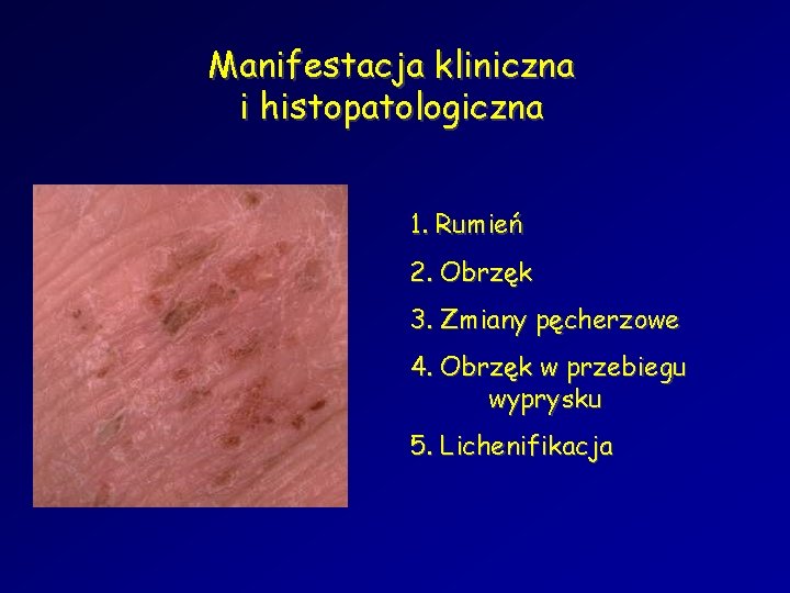 Manifestacja kliniczna i histopatologiczna 1. Rumień 2. Obrzęk 3. Zmiany pęcherzowe 4. Obrzęk w