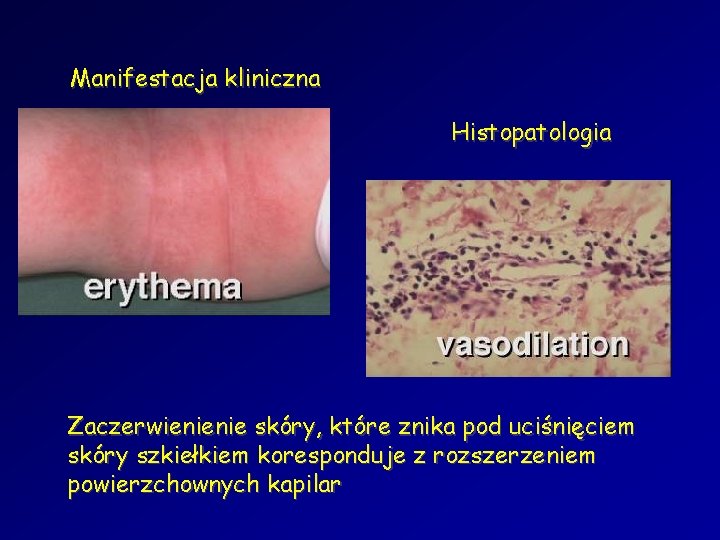 Manifestacja kliniczna Histopatologia Zaczerwienienie skóry, które znika pod uciśnięciem skóry szkiełkiem koresponduje z rozszerzeniem