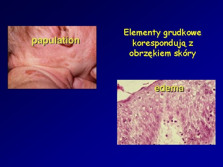 Elementy grudkowe korespondują z obrzękiem skóry 