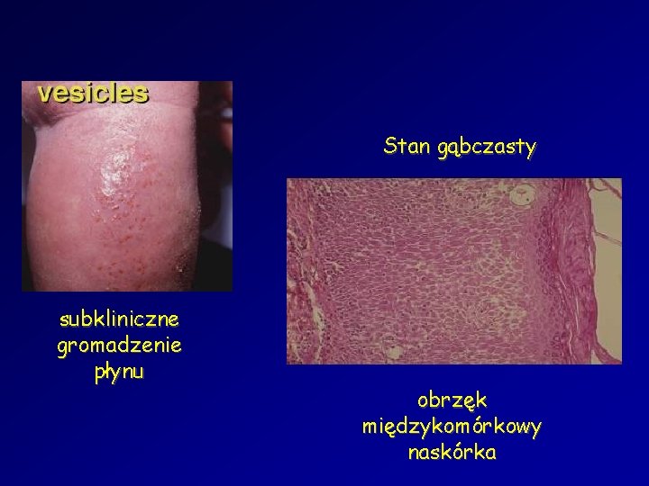 Stan gąbczasty subkliniczne gromadzenie płynu obrzęk międzykomórkowy naskórka 