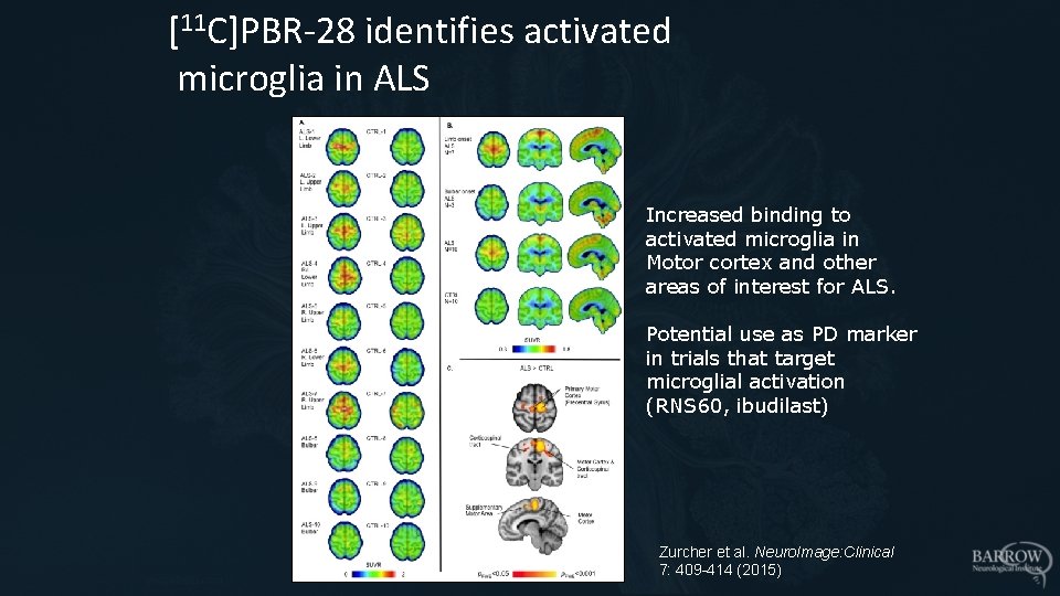 [11 C]PBR-28 identifies activated microglia in ALS Increased binding to activated microglia in Motor