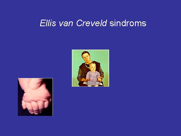 Ellis van Creveld sindroms 