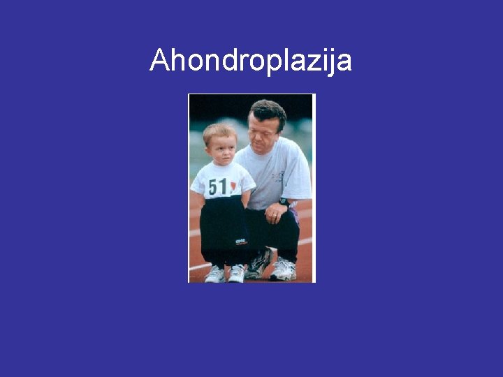 Ahondroplazija 