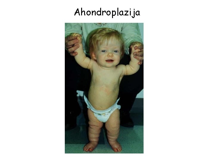 Ahondroplazija 