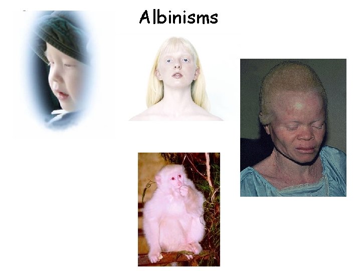 Albinisms 