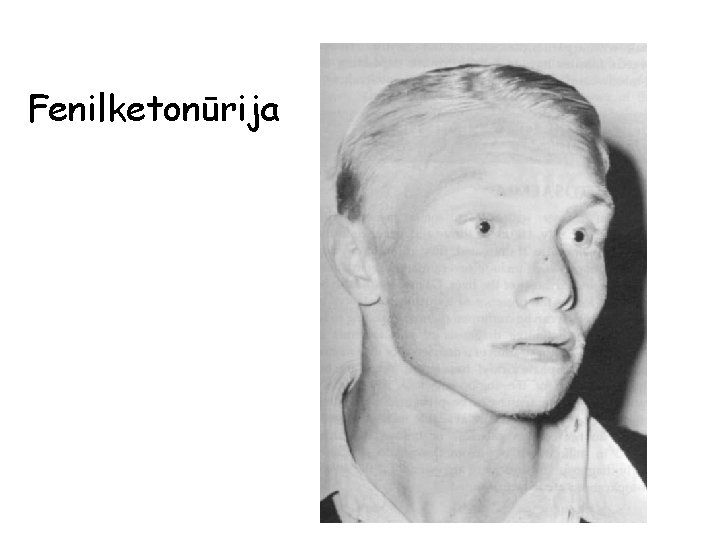 Fenilketonūrija 