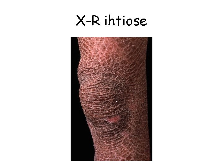 X-R ihtiose 