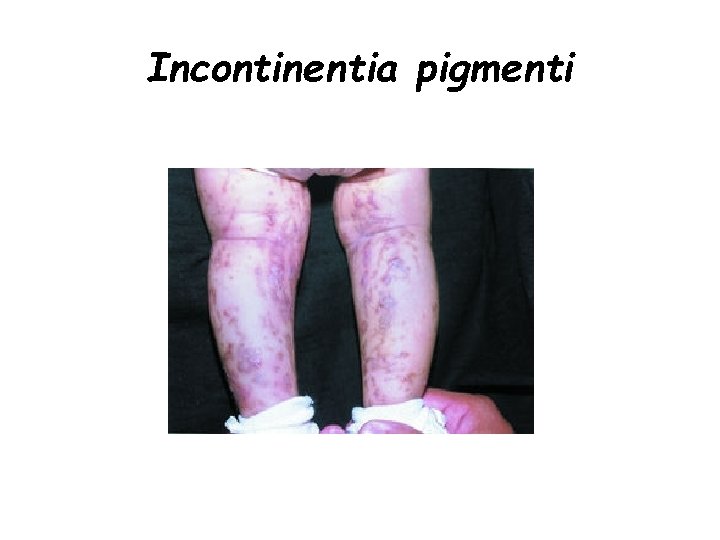 Incontinentia pigmenti 