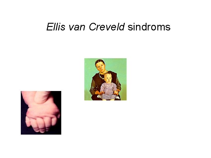 Ellis van Creveld sindroms 