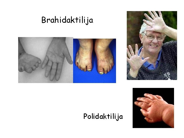 Brahidaktilija Polidaktilija 