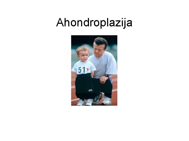 Ahondroplazija 