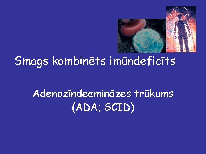 Smags kombinēts imūndeficīts Adenozīndeamināzes trūkums (ADA; SCID) 