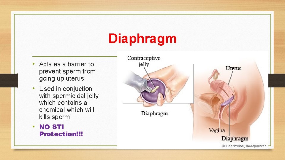 Diaphragm • Acts as a barrier to prevent sperm from going up uterus •