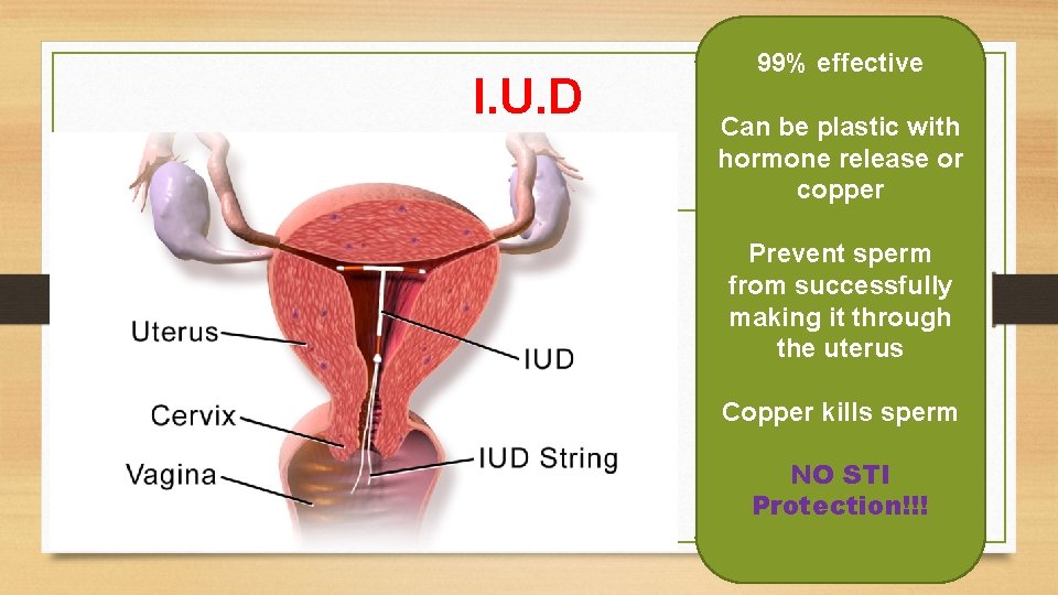 I. U. D 99% effective Can be plastic with hormone release or copper Prevent