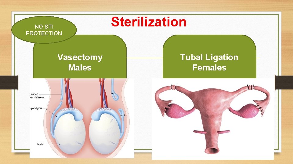 NO STI PROTECTION Vasectomy Males Sterilization Tubal Ligation Females 
