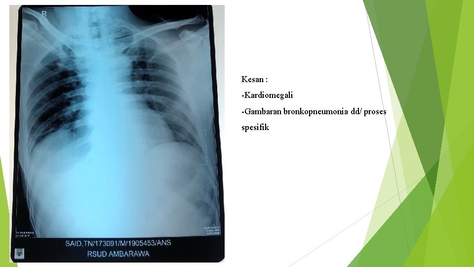 Kesan : -Kardiomegali -Gambaran bronkopneumonia dd/ proses spesifik 