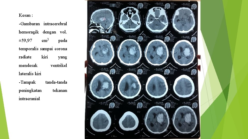 Kesan : -Gambaran intracerebral hemoragik dengan vol. ± 59, 97 cm 3 pada temporalis