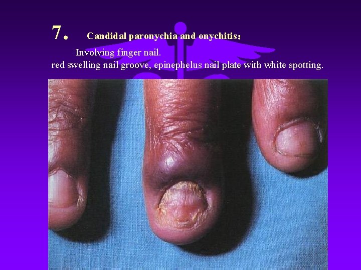 7． Candidal paronychia and onychitis： Involving finger nail. red swelling nail groove, epinephelus nail