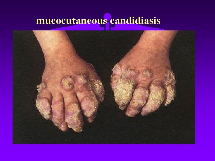 mucocutaneous candidiasis 