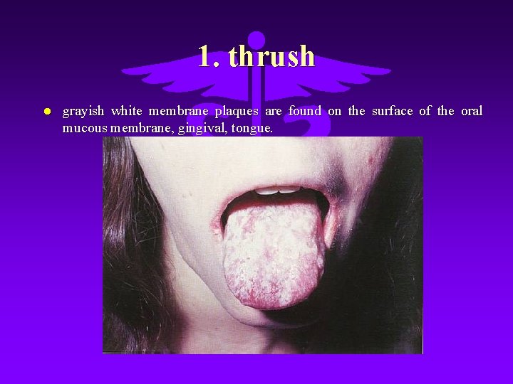1. thrush l grayish white membrane plaques are found on the surface of the