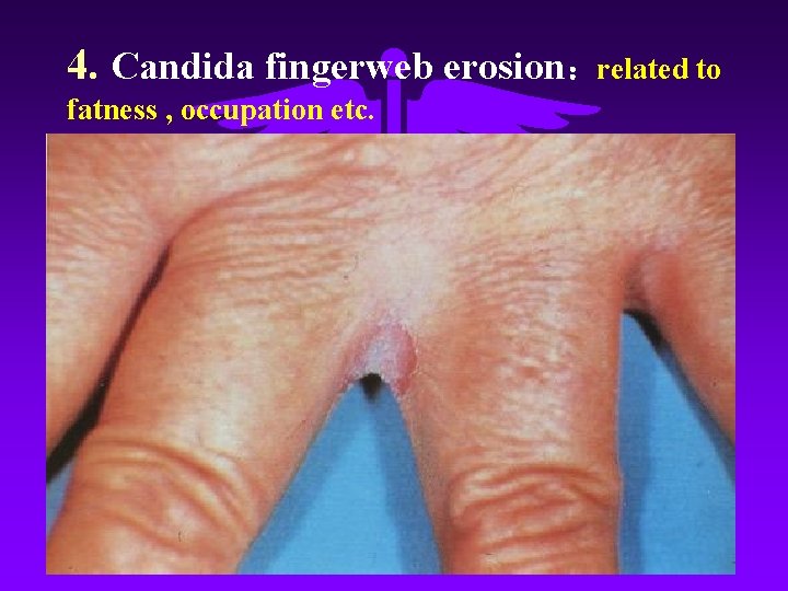 4. Candida fingerweb erosion：related to fatness , occupation etc. 