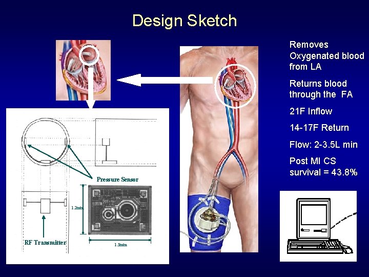 Design Sketch Removes Oxygenated blood from LA Returns blood through the FA 21 F