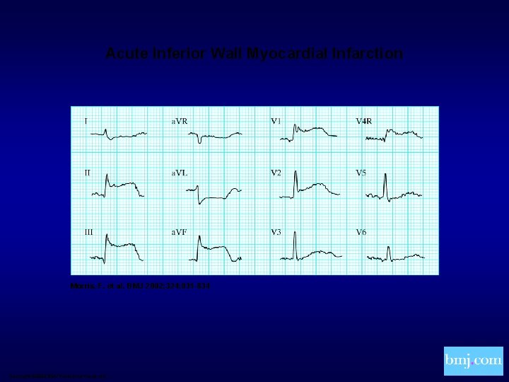 Acute Inferior Wall Myocardial Infarction Morris, F. et al. BMJ 2002; 324: 831 -834