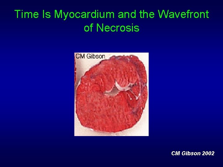 Time Is Myocardium and the Wavefront of Necrosis CM Gibson 2002 