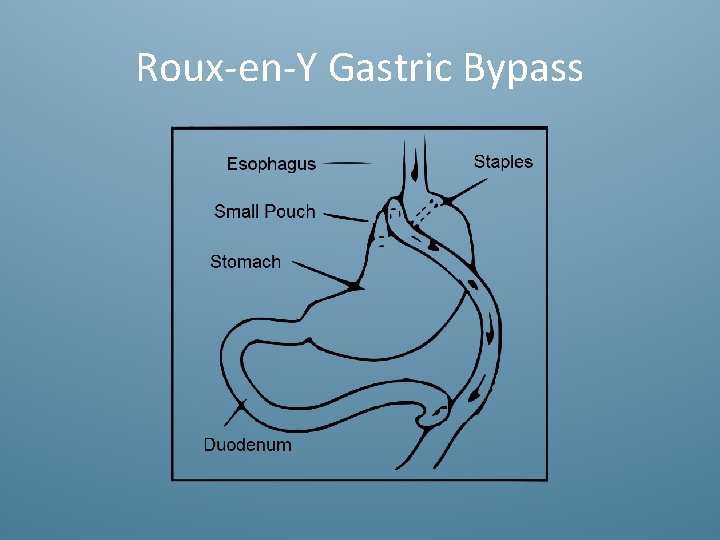 Roux-en-Y Gastric Bypass 