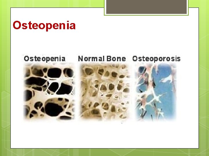 Osteopenia 
