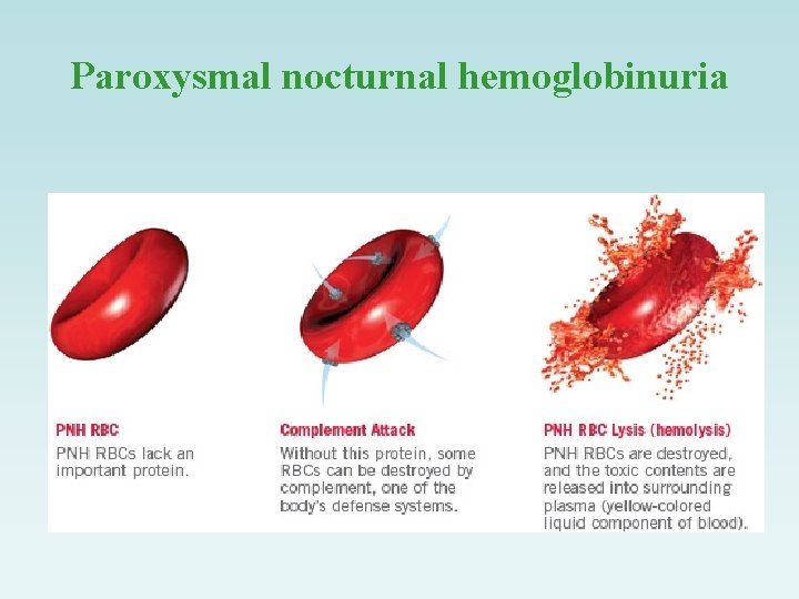 Paroxysmal nocturnal hemoglobinuria 