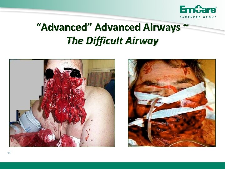 “Advanced” Advanced Airways ~ The Difficult Airway 16 