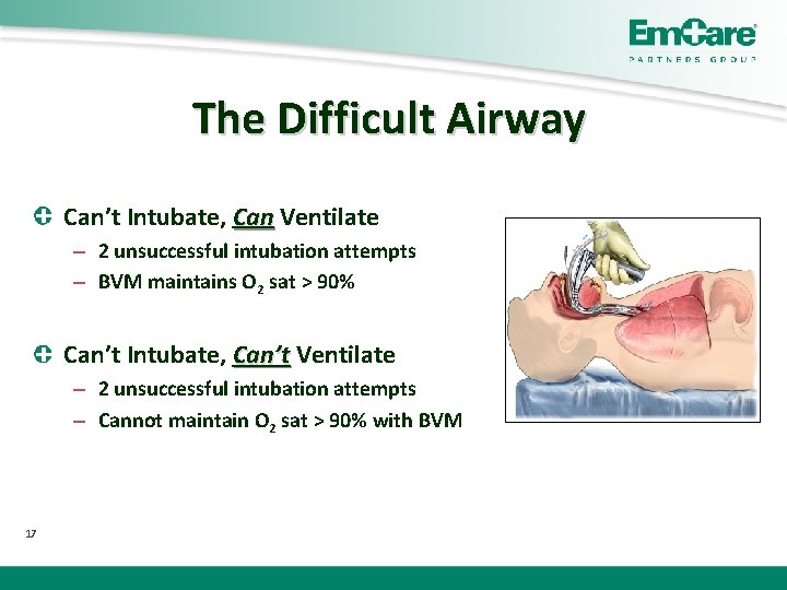 The Difficult Airway Can’t Intubate, Can Ventilate – 2 unsuccessful intubation attempts – BVM
