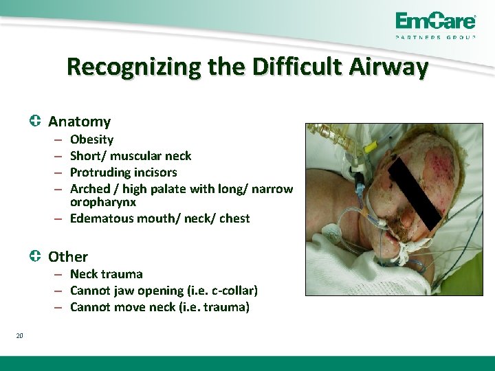 Recognizing the Difficult Airway Anatomy Obesity Short/ muscular neck Protruding incisors Arched / high