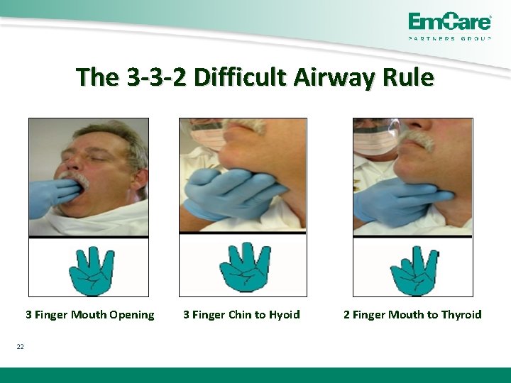 The 3 -3 -2 Difficult Airway Rule 3 Finger Mouth Opening 22 3 Finger