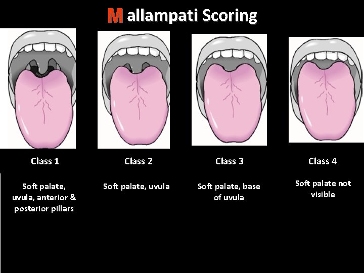 Mallampati Scoring M Class 1 Class 2 Class 3 Class 4 Soft palate, uvula,