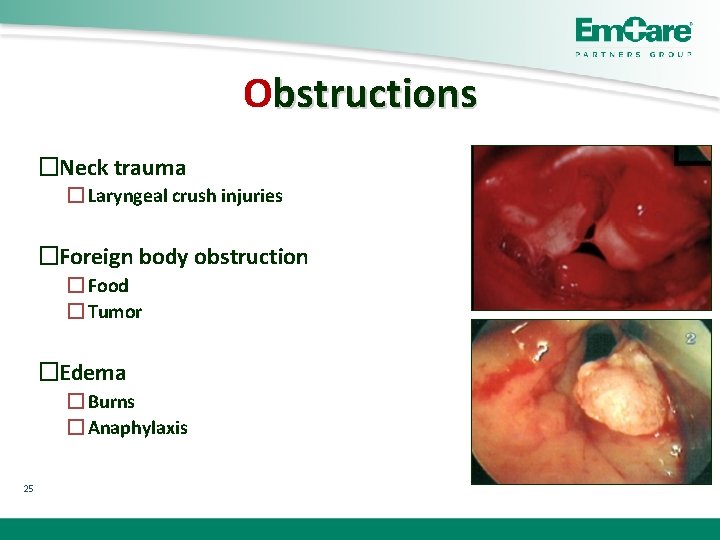 Obstructions �Neck trauma � Laryngeal crush injuries �Foreign body obstruction � Food � Tumor