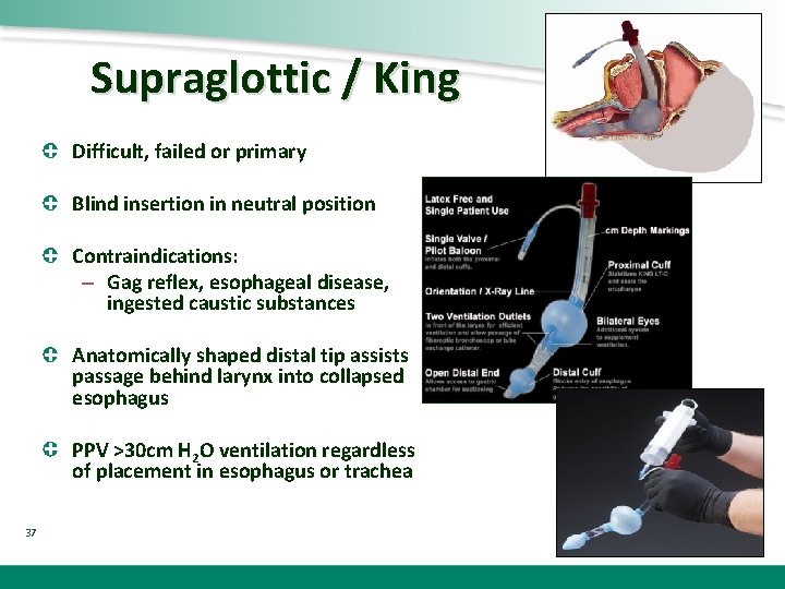 Supraglottic / King Difficult, failed or primary Blind insertion in neutral position Contraindications: –