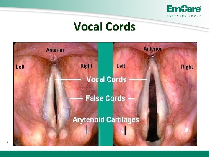 Vocal Cords 7 