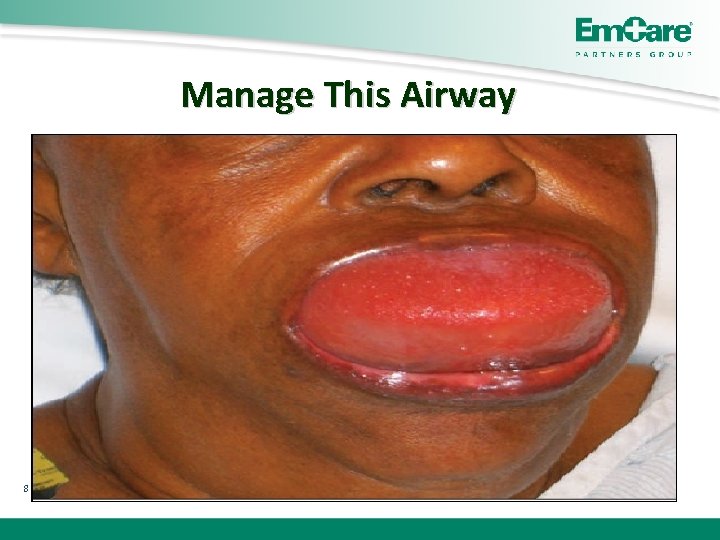 Manage This Airway 8 A: Tongue Edema Post Lye Injury Swelling B: Neck Injury