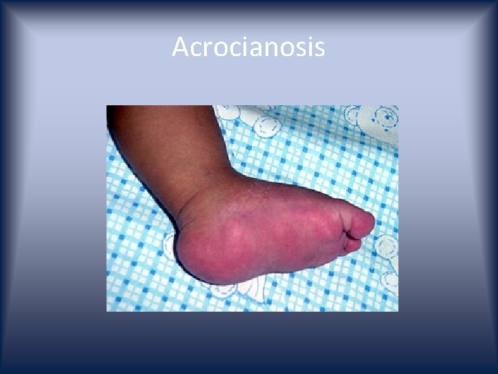 Acrocianosis 