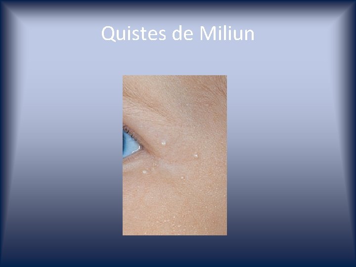 Quistes de Miliun 