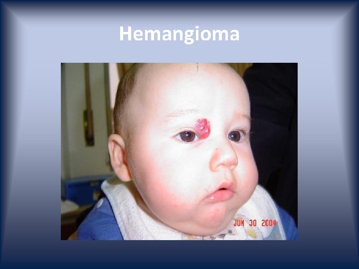 Hemangioma 