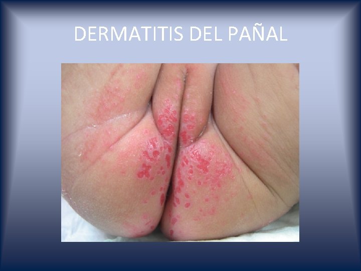 DERMATITIS DEL PAÑAL 