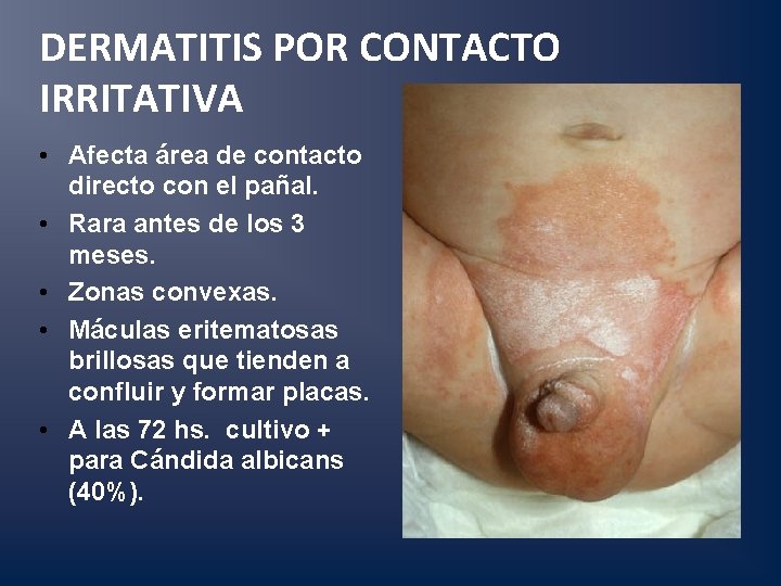 DERMATITIS POR CONTACTO IRRITATIVA • Afecta área de contacto directo con el pañal. •